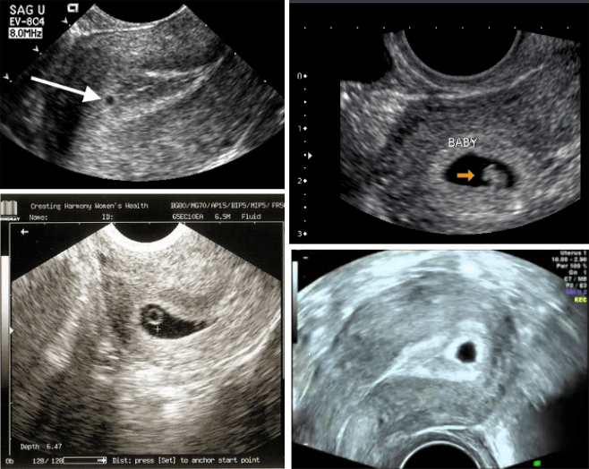 1 Month Pregnant: What to Expect?