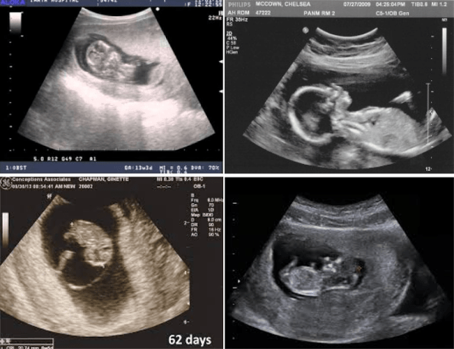 Ultrasound in 2 month of pregnancy