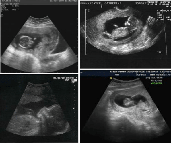 3 month ultrasound