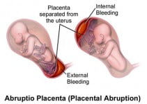 Placental Abruption – Symptoms, Causes, Prevention & Treatment