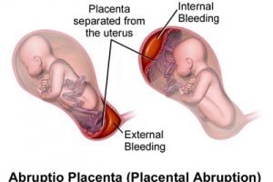 Placental Abruption – Symptoms, Causes, Prevention & Treatment