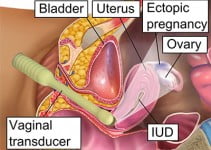 Ectopic Pregnancy Signs, Risk Factors & Diagnosis