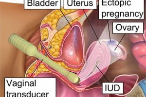 Ectopic Pregnancy Signs, Risk Factors & Diagnosis