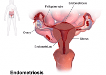 The Signs and Stages of Endometriosis