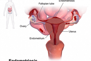 The Signs and Stages of Endometriosis