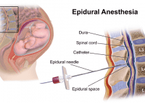 Epidural Anesthesia – Benefits, Side Effects And Risks