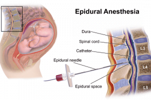 Epidural Anesthesia – Benefits, Side Effects And Risks