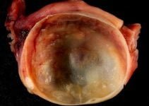 The Whats, Whys, and Hows of Ovarian Cysts The Whats, Whys, and Hows of Ovarian Cysts