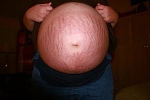 Pregnancy Stretch Marks: What Women Should Know and How to Get Rid of Them