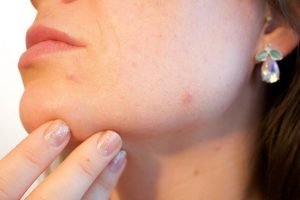 Salicylic Acid and Pregnancy: Is Acne Medication Safe?
