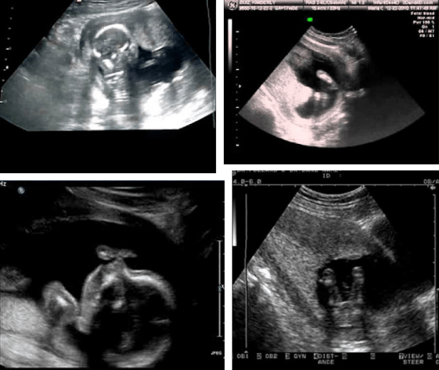 4 month ultrasound