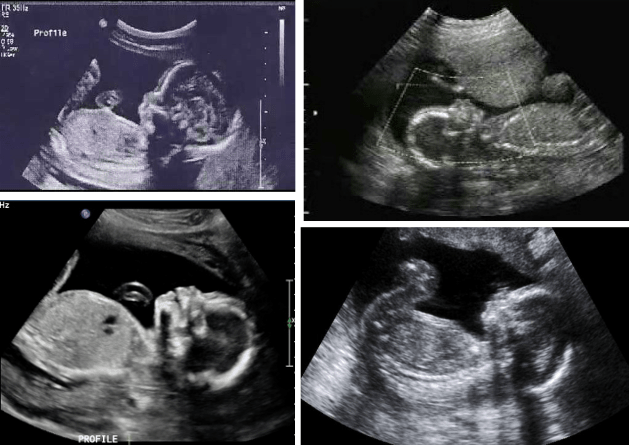 5 month ultrasound