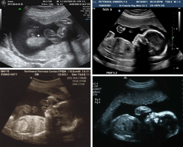 6 month pregnant ultrasound