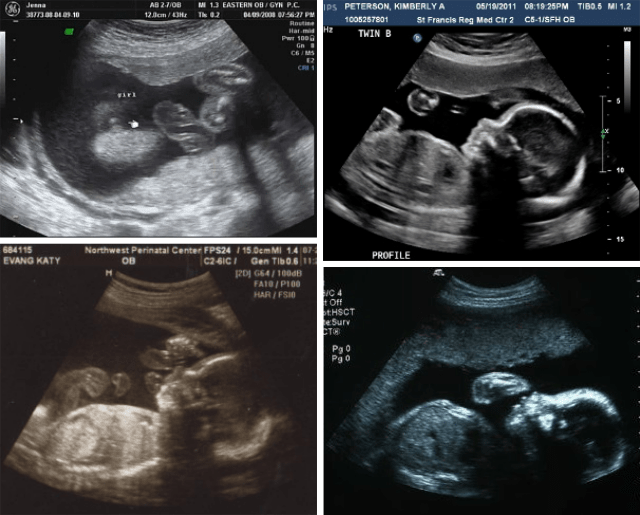 6 Month Pregnant What To Expect Symptoms And Signs 6 Month Pregnant What To Expect Symptoms And Signs