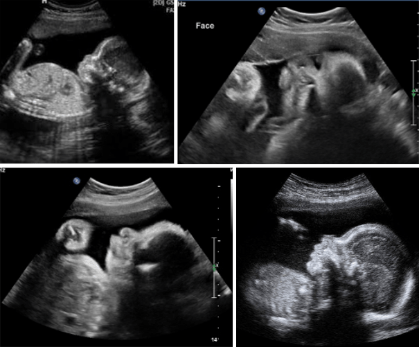 8 month pregnant ultrasound