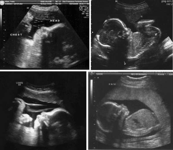 9 month pregnant ultrasound
