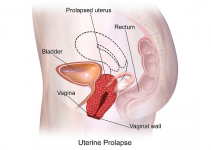 Uterine Prolapse in Pregnancy: Causes, Precautions, Treatments & Complications