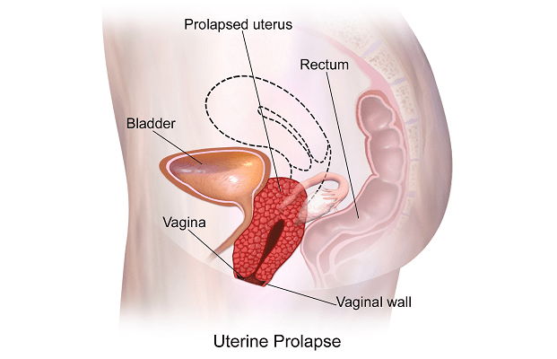 And pregnancy uterus Polyps In