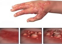 Eczema in Toddlers Eczema in Toddlers