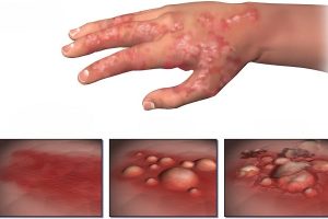 Eczema in Toddlers