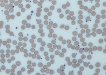 Low Platelet Count In Pregnancy