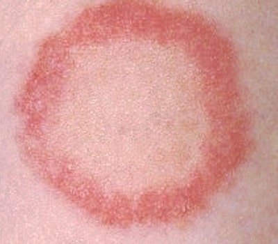 Ringworm in babies: Causes, Prevention, Symptoms & Treatment