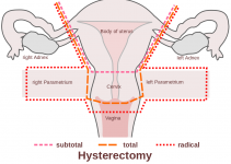 Menstrual Cycle After Hysterectomy