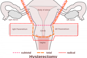 Menstrual Cycle After Hysterectomy Menstrual Cycle After Hysterectomy