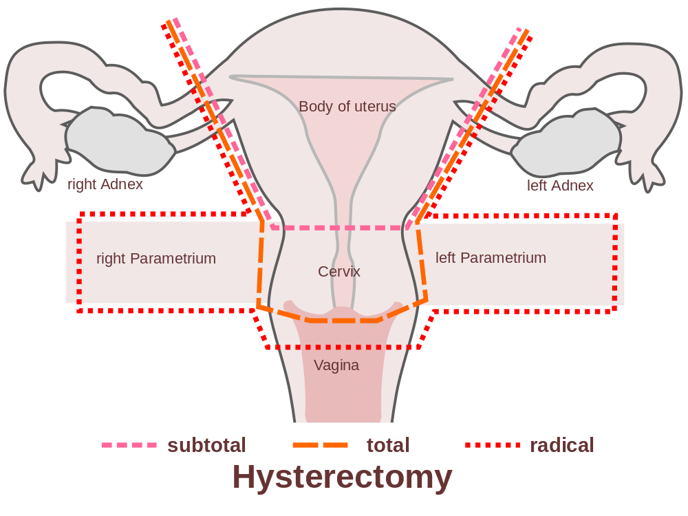 long distance travel after hysterectomy